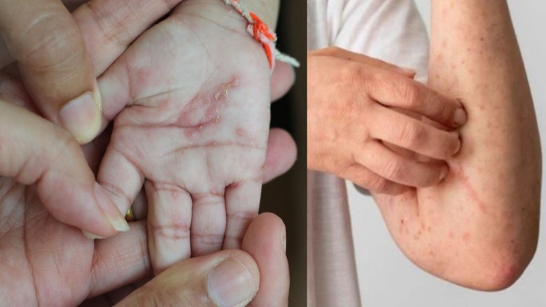 শরীরের চিপায়-চাপায় স্ক্যাবিস, পাত্তা না দিলেই বিপদ...