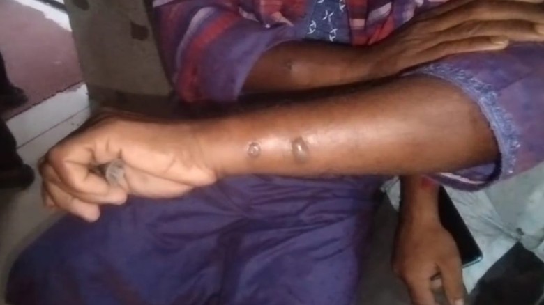 গাইবান্ধায় ১১ জনের শরীরে অ্যানথ্রাক্সের উপসর্গ...