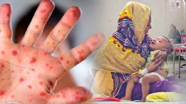 হাম ও উপসর্গে আরো ৯ মৃত্যু...
